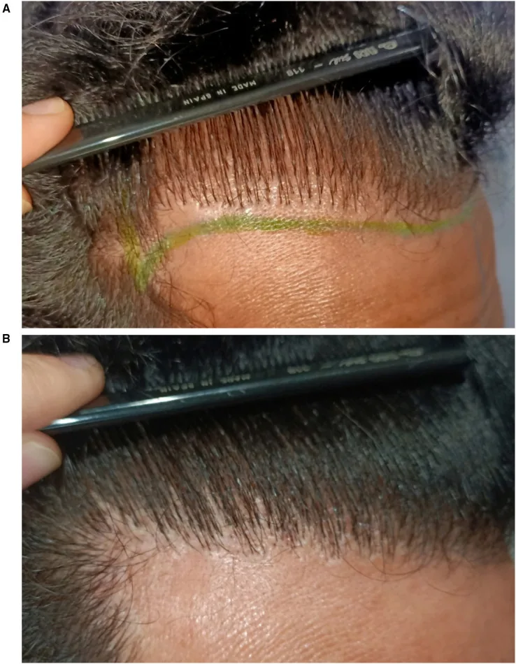 A frontal hairline after transplantation showing unnatural multi-hair grafts in the front row, then corrected with single-hair grafts for a softer transition