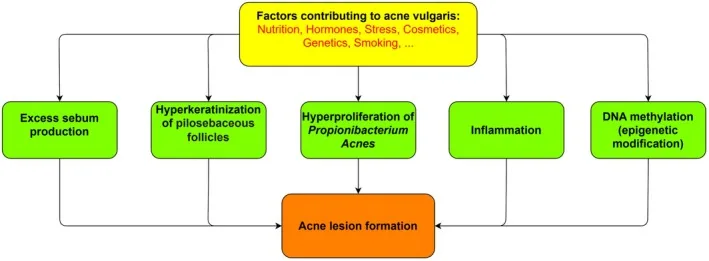 Diagram of the factors contributing to acne: excess oil, blocked follicles, bacterial overgrowth and inflammation, as background to what honey can and can't do for acne