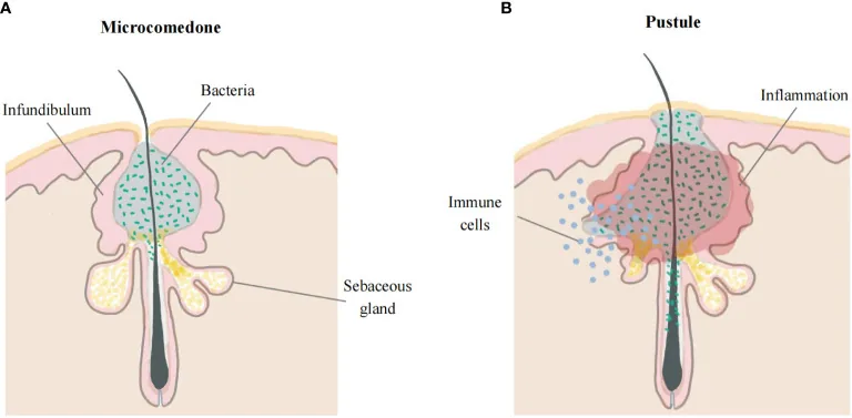Illustration of a skin pore: on the left a small plug blocked with oil and bacteria, on the right an inflamed pustule surrounded by immune cells, showing how inflamed acne develops