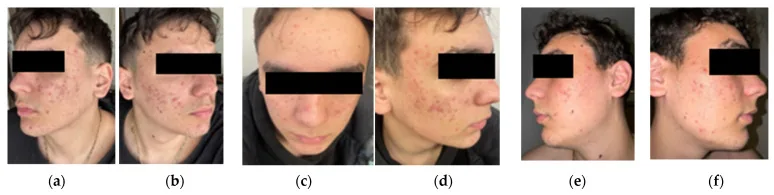 A young man's face with red inflamed spots and pustules on the cheeks and jaw, then gradual improvement in later photographs after months of medical treatment for inflamed acne