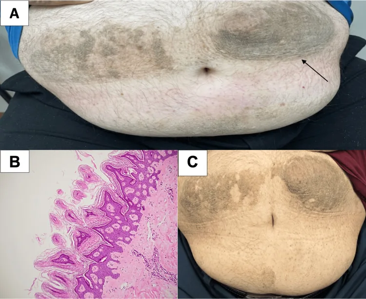 Dark, thickened, velvety skin either side of the navel in a published case of acanthosis nigricans, a common cause of inner thigh darkening, with histology and improvement after treating the cause