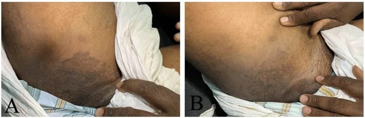 Brown, scaly patches in the groin fold caused by a bacterial infection that mimics inner thigh darkening, then near-complete clearance after treatment
