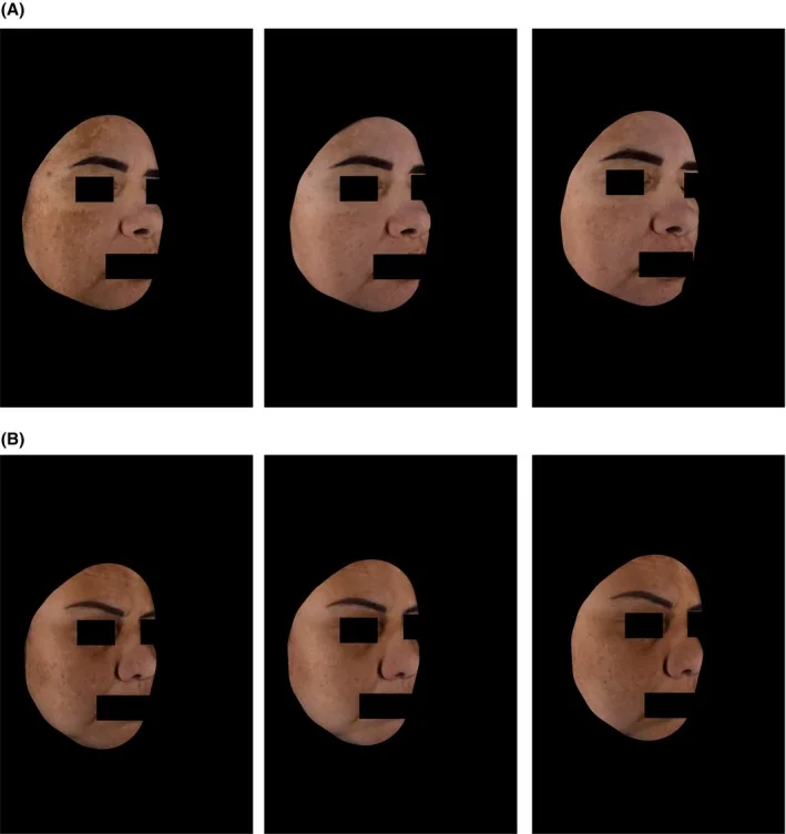 Side views of two women with melasma at baseline and after three and five months of a niacinamide-containing serum and of hydroquinone, an ingredient common in lightening creams such as ISIS Pharma's
