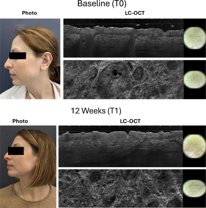 Side views of a woman with melasma at baseline and after twelve weeks of a sunscreen containing niacinamide, with optical skin imaging, the foundation of any lightening routine with ISIS Pharma products