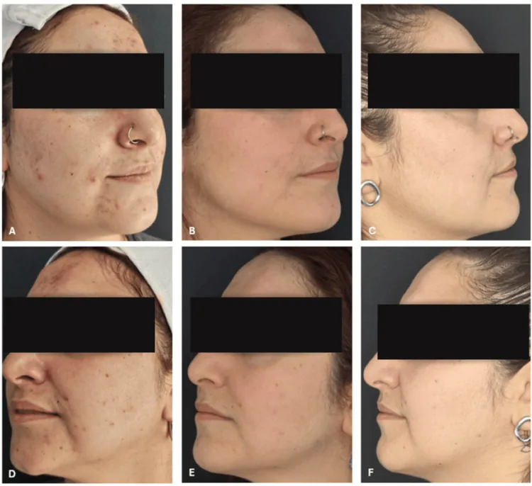 Side views of a woman with severe acne and scarring at baseline, then one and three months after combined isotretinoin and laser treatment, which changes how procedures are timed with isotretinoin