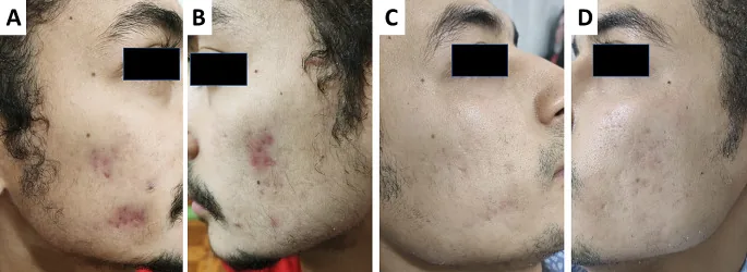 A patient's face from both sides with red post-acne marks before treatment, then their clearance after isotretinoin with laser, marks that isotretinoin helps fade