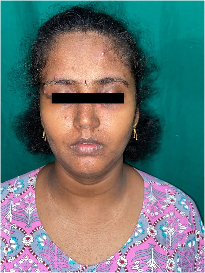 A woman's face with small scattered pustules on the forehead and around the eyes, an example of heat rash bumps after heat and sweating