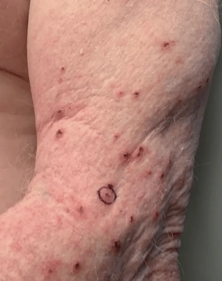 An arm with scattered small red bumps and scratch marks, with a circle around the biopsy site, from a case of scabies whose diagnosis was delayed