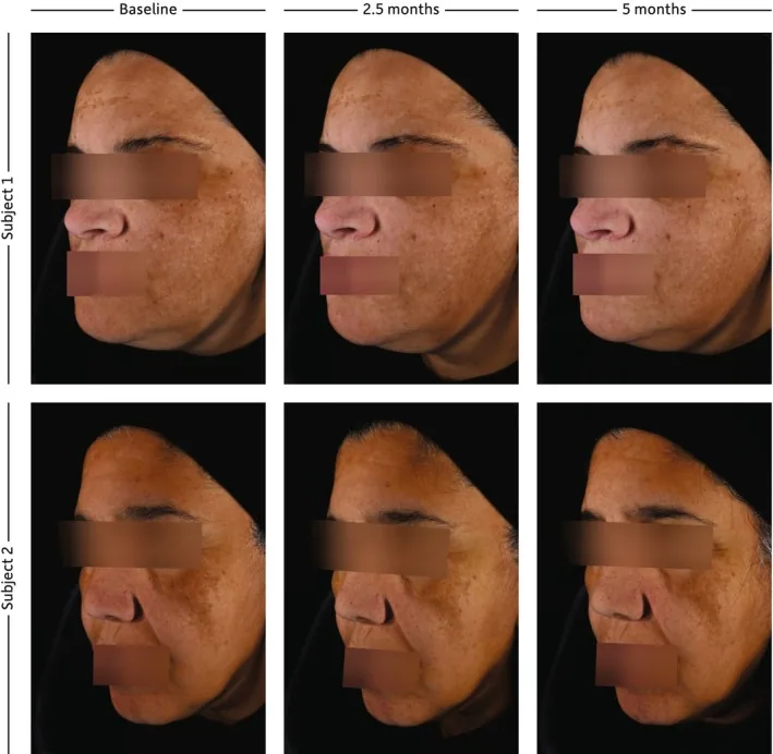 Side views of two participants with melasma at baseline, two and a half months and five months of sunscreen use, the foundation of any melasma treatment for the face