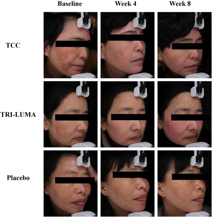 Photographs of participants with melasma at baseline and after four and eight weeks of two versions of triple combination cream and of placebo, one of the best-known melasma treatments for the face