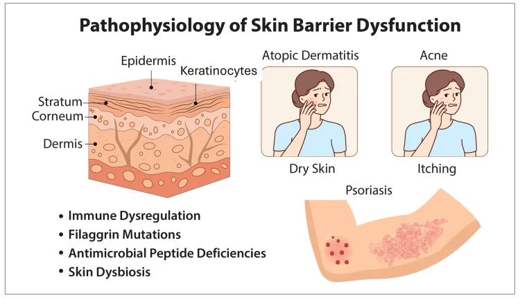 Illustration of the skin layers and skin barrier dysfunction, with associated conditions such as eczema, acne, dryness, itching and psoriasis, explaining the benefits of moisturising