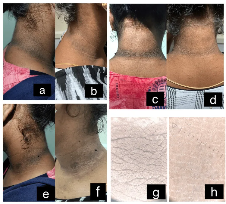Photographs of a neck with acanthosis nigricans from both sides and the back, before and after fractional laser, with dermatoscope images, one treatment for a dark neck