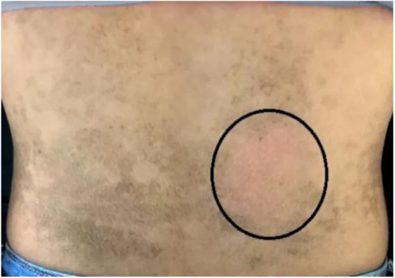 A back with mottled brown patches and a circle where the skin looks normal after wiping with rubbing alcohol, a test that reveals one kind of darkening before trying to treat a dark neck