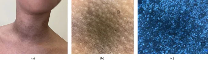 A child's neck with mottled, net-like brown patches, plus two dermatoscope images, a kind of dark neck that wipes off rather than needing treatment