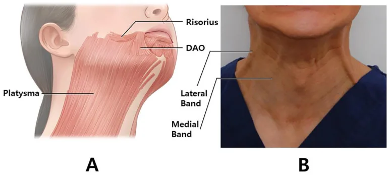 Illustration of the broad platysma muscle running from the chest to the jaw, and a photograph of a neck showing the medial and lateral vertical bands, one type of neck wrinkles