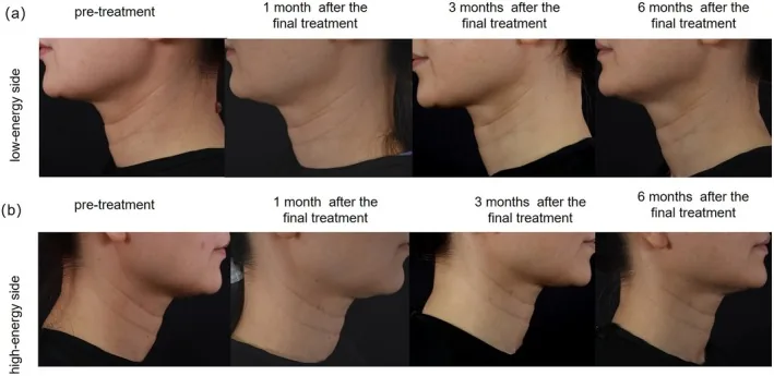 Side views of the neck showing horizontal lines before radiofrequency treatment and one, three and six months afterwards on both sides of the neck, the most familiar neck wrinkles in pictures