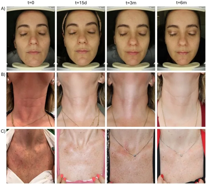 Photographs of the face, neck and upper chest of participants before a skin booster injection and fifteen days, three and six months afterwards, one treatment for neck wrinkles