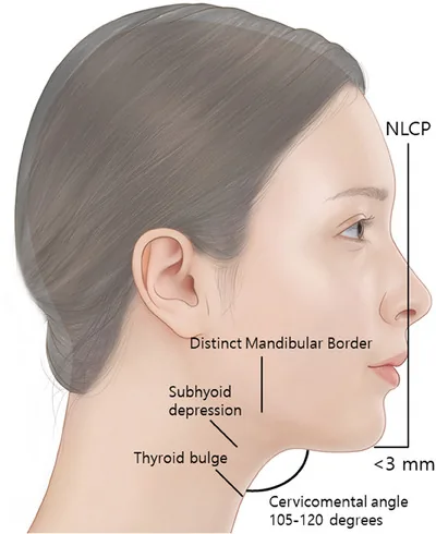 Side-view illustration of a woman's face showing a defined jaw border, the ideal chin-neck angle and neck landmarks relevant to non-surgical chin augmentation
