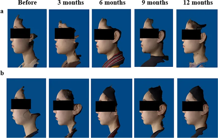 Sequential side profiles of two patients before chin filler and at three, six, nine and twelve months afterwards