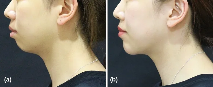 Side view of a woman before chin filler and six months afterwards, showing a more projected chin and a clearer jawline