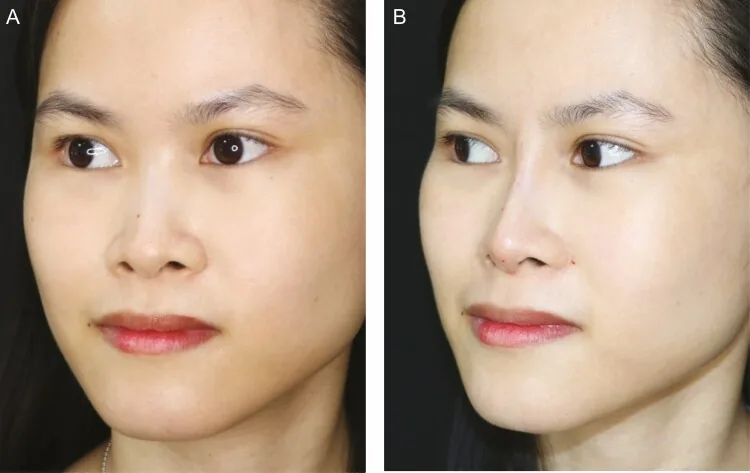 A woman with a low nasal bridge before a non-surgical nose job, then immediately after hyaluronic acid filler with a higher, clearer bridge