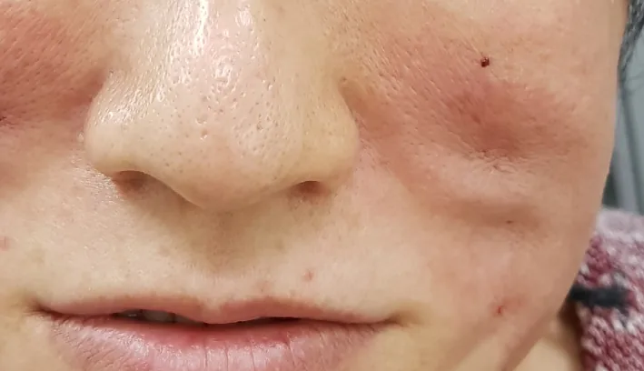 A small depression and dimpling in the cheek skin over the path of a thread after a thread lift procedure