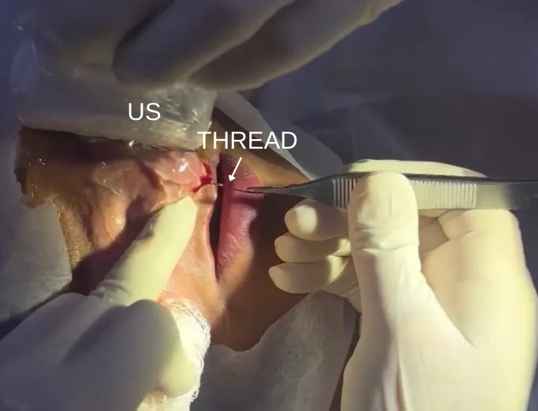 Removal of a polydioxanone thread from a patient's nose with surgical forceps under ultrasound guidance after a nose thread lift