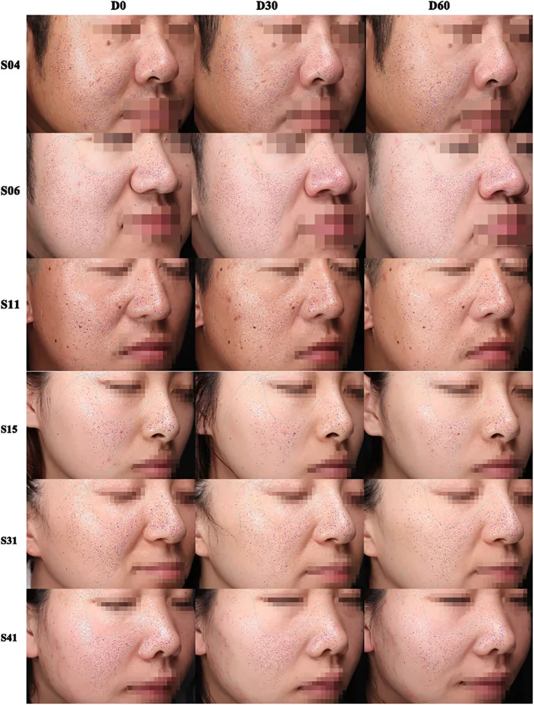 Side views of faces with pores marked at baseline and after thirty and sixty days, with fewer visible pores over time, an example of improvement in the appearance of oily skin
