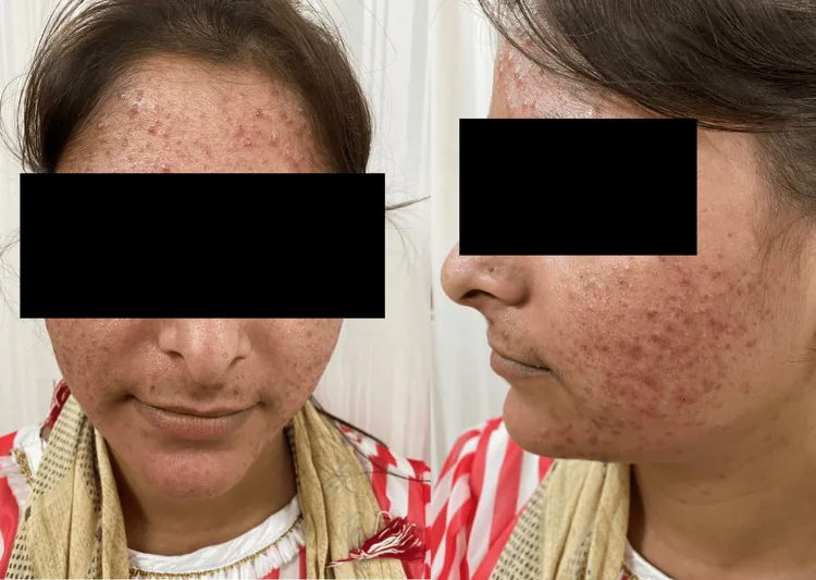 Front and side views of a woman's face with many small, uniform red spots across the forehead and cheeks after steroid and fairness creams, one harm of Pakistani whitening creams