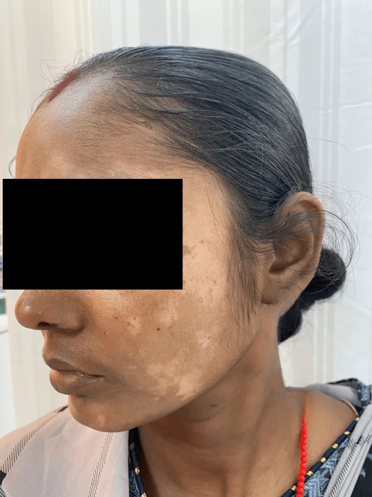 A woman's face with irregular pale patches on the cheek and jaw after misuse of steroid and fairness creams, one harm of Pakistani whitening creams