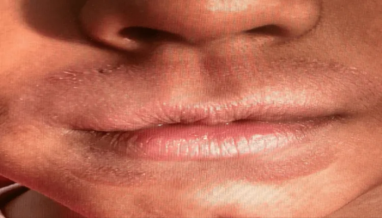 Dry, darkened skin in a ring around the lips of a child who habitually licked them, the commonest cause of dark skin around the mouth, which creams alone don't fix