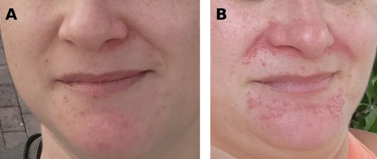 A face in the early stage of perioral dermatitis with a few bumps, then a more severe stage with red bumps around the nose, mouth and chin, a cause of darkening around the mouth after inflammation