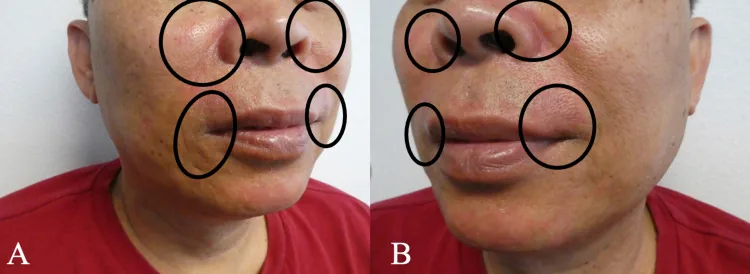 A man's face from both sides, with circles around redness beside the nose and around the mouth after using a potent steroid cream on the face, a cause of dark skin around the mouth that must be stopped under supervision
