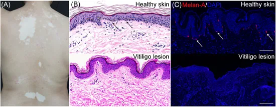 A person's back with clear white vitiligo patches, with microscope images showing pigment cells in healthy skin and their absence in a vitiligo patch, illustrating one cause of light skin pigmentation