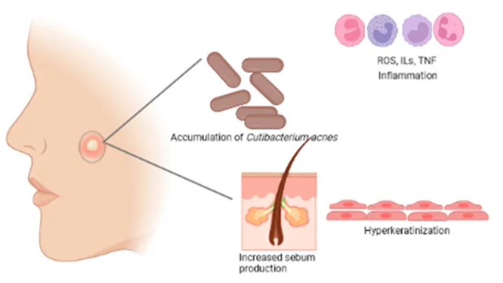Diagram of the four factors in acne: increased sebum, pore blockage, bacterial build-up and inflammation, which a pimple drying lotion targets