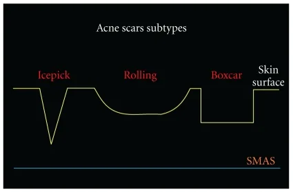 Diagram of the three acne scar shapes, icepick, rolling and boxcar, which popping deep pimples can leave behind