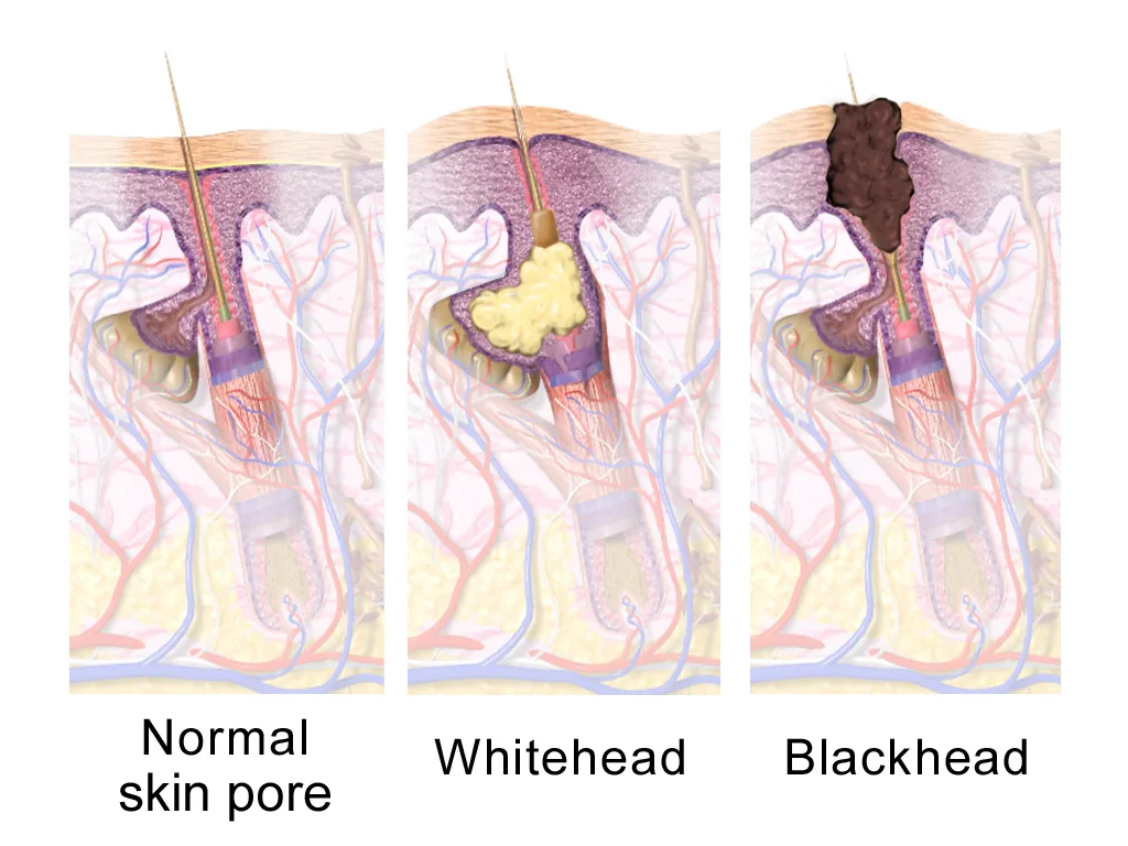 Diagram comparing a normal pore, a closed whitehead and an open blackhead, showing what happens when popping pimples