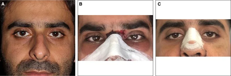 A rhinoplasty patient before surgery, on day one with an external splint and bruising around the eyes, and later with tape on the nasal bridge