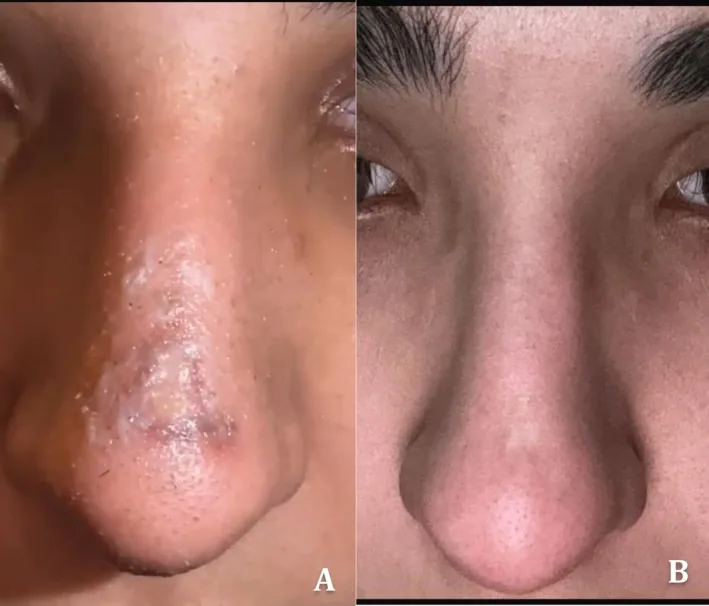 The skin of the nasal bridge after rhinoplasty showing a localised ulcerated, discoloured patch, then healed months later with a minimal scar