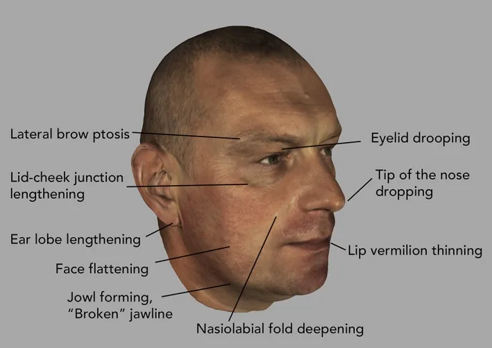 Three-dimensional face scan marking ageing signs such as brow and eyelid drooping, face flattening, jowls along the jawline and a deeper nasolabial fold, among the causes of a sagging face