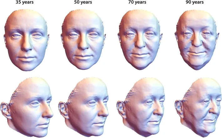 Three-dimensional models of a woman's face shape at thirty-five, fifty, seventy and ninety showing flattening and tissue descent with age, among the causes of a sagging face