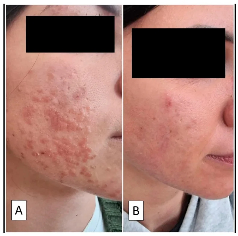 Small flat bumps clustered on the cheek in flat warts, then near-complete clearance after peel sessions, one kind of bump that can look skin-coloured