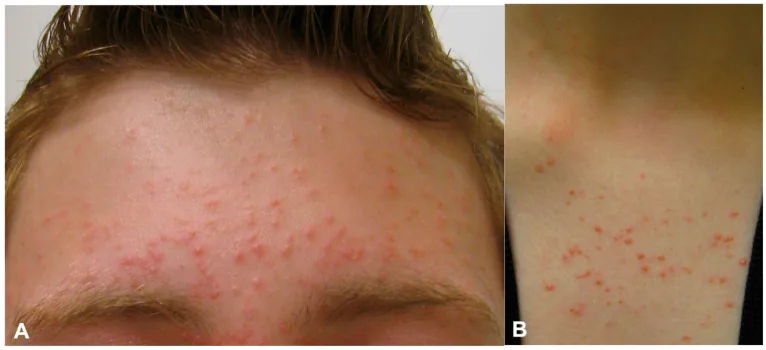 Small uniform bumps on the forehead, hairline and upper chest in fungal folliculitis, which can look like small skin-coloured bumps on the face