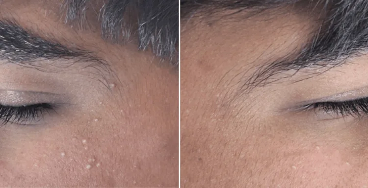 Small firm white bumps on the temples near the eye, milia, one kind of small skin-coloured bump on the face