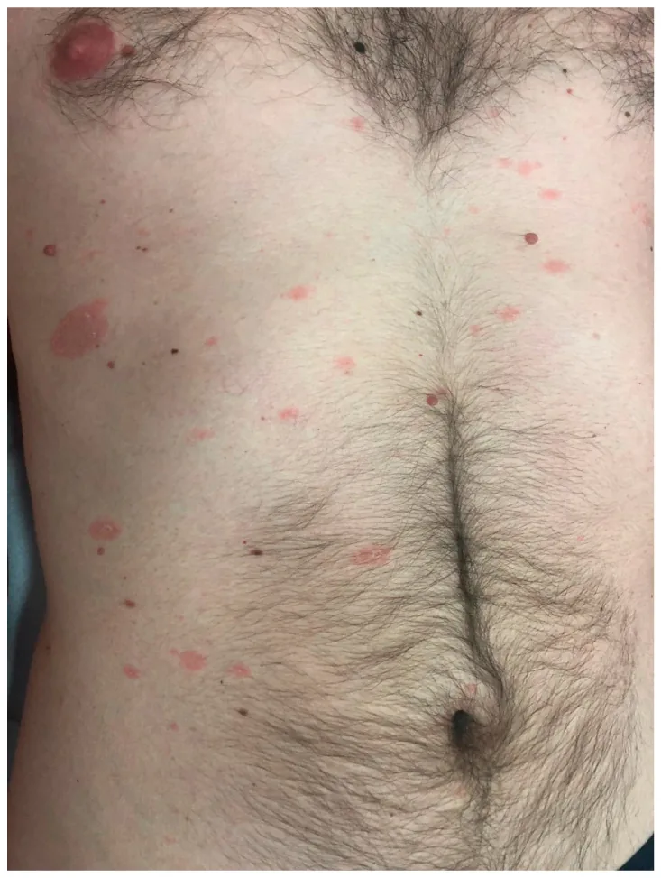A man's trunk with a large scaly pink patch below the chest and smaller pink patches across the trunk in pityriasis rosea, one type of red skin spot