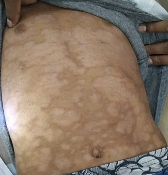 An abdomen with multiple irregular, merging pale patches in tinea versicolor, one of the best-known types of white skin spots