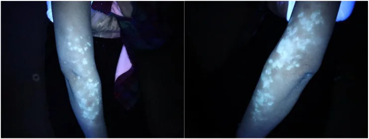 Two arms under a Wood's lamp with vitiligo patches glowing a distinct blue-white, which separates them from other types of white skin spots