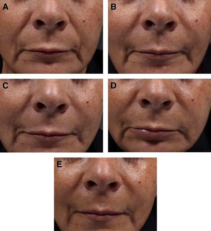 Photographs of a severe nasolabial fold before filler, then mild at twelve, twenty-four and thirty-six weeks, then moderate at forty-eight weeks, a treatment for smile lines