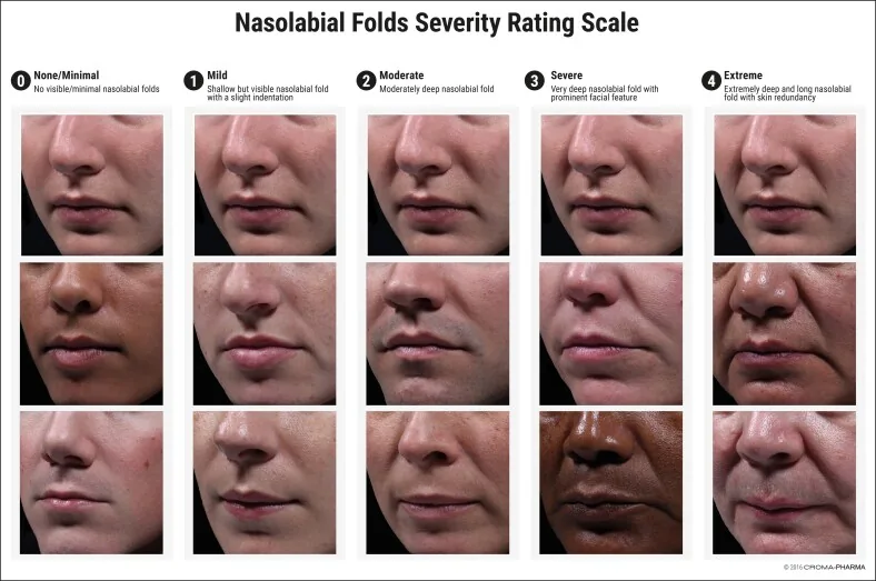 A five-point scale of nasolabial fold depth, from almost no line to a deep, long fold with excess skin, the most familiar type of smile lines