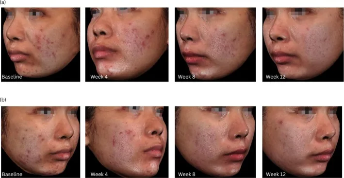 Both sides of a face with acne at baseline and after four, eight and twelve weeks of a topical retinoid, with gradual improvement, illustrating what to expect from Sure Cure gel
